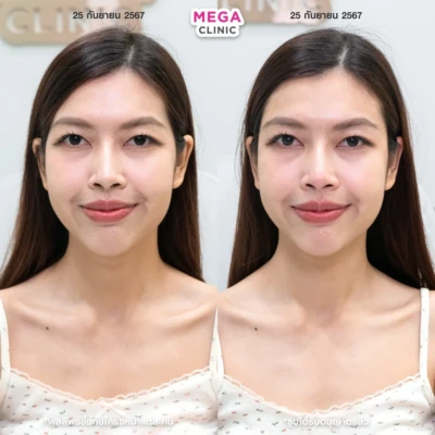 ฟิลเลอร์ขมับ รีวิว