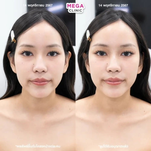 ฟิลเลอร์ขมับ รีวิว