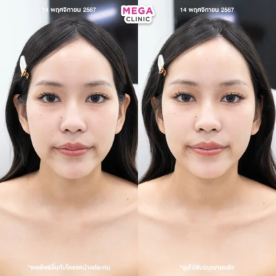 ฟิลเลอร์ขมับ รีวิว