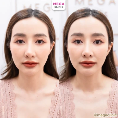 ฟิลเลอร์ขมับ รีวิว