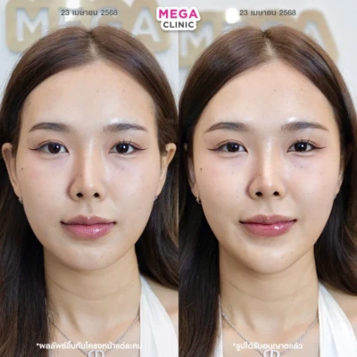 ฟิลเลอร์ขมับ รีวิว