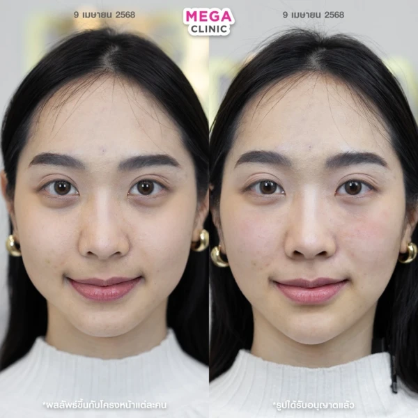 รีวิว ฟิลเลอร์คาง