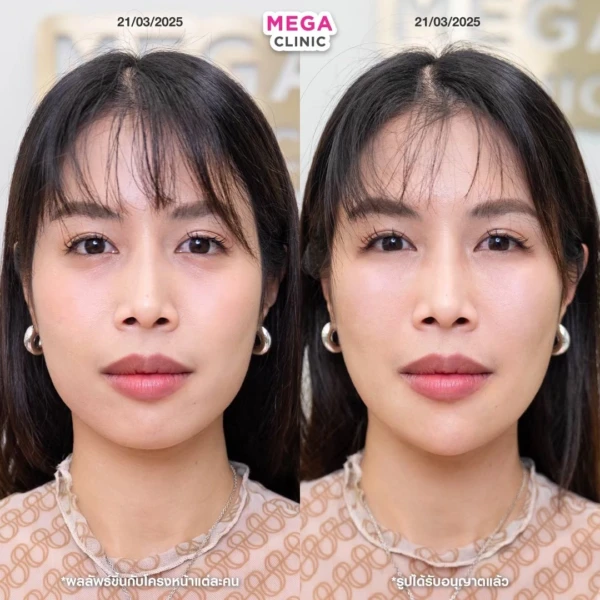 รีวิว ฟิลเลอร์คาง