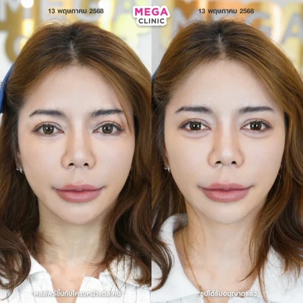 ฉีดดอลลี่อาย รีวิว