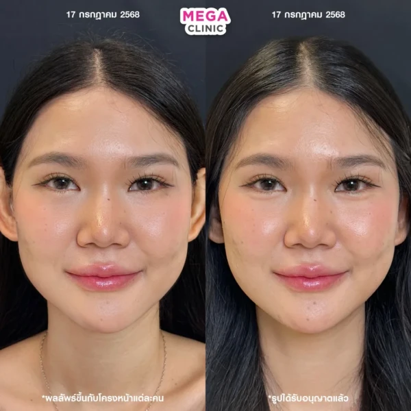 ฉีดดอลลี่อาย รีวิว