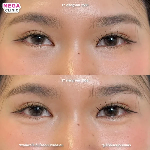 ฉีดดอลลี่อาย รีวิว