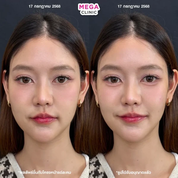 ฉีดดอลลี่อาย รีวิว