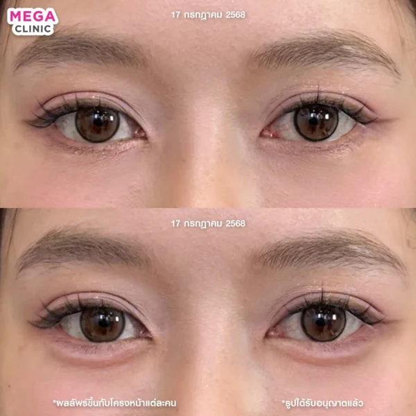 ฉีดดอลลี่อาย รีวิว