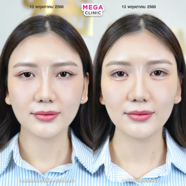 ฉีดดอลลี่อาย รีวิว