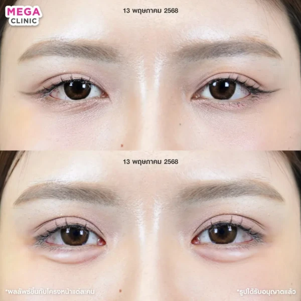 ฉีดดอลลี่อาย รีวิว