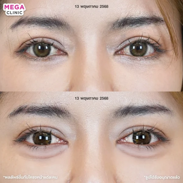 ฉีดดอลลี่อาย รีวิว