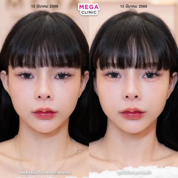 ฉีดดอลลี่อาย รีวิว