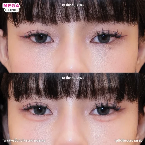 ฉีดดอลลี่อาย รีวิว