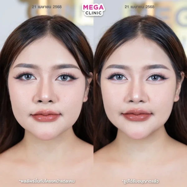 ฉีดดอลลี่อาย รีวิว