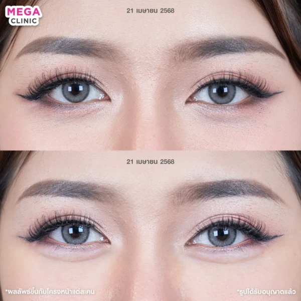 ฉีดดอลลี่อาย รีวิว