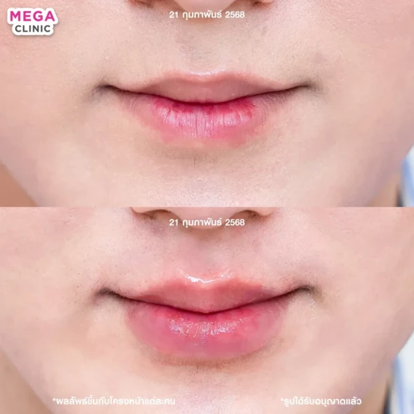 รีวิว ฟิลเลอร์ปาก