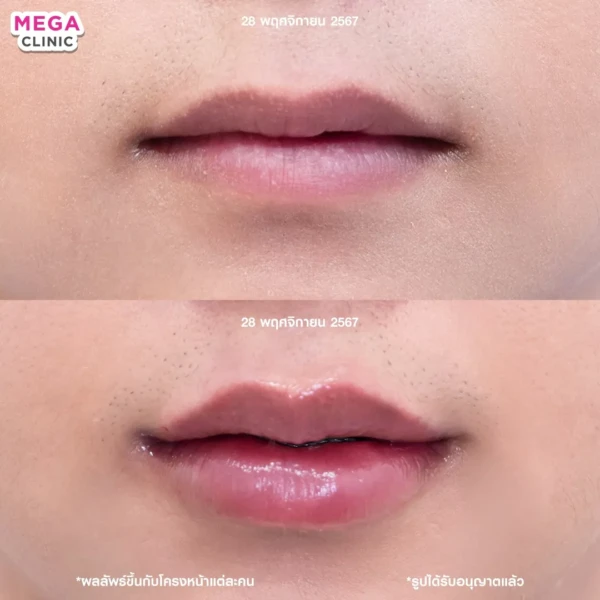 รีวิว ฟิลเลอร์ปาก