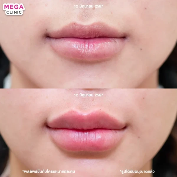 รีวิว ฟิลเลอร์ปาก