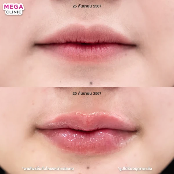 รีวิว ฟิลเลอร์ปาก