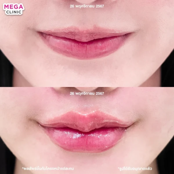 รีวิว ฟิลเลอร์ปาก