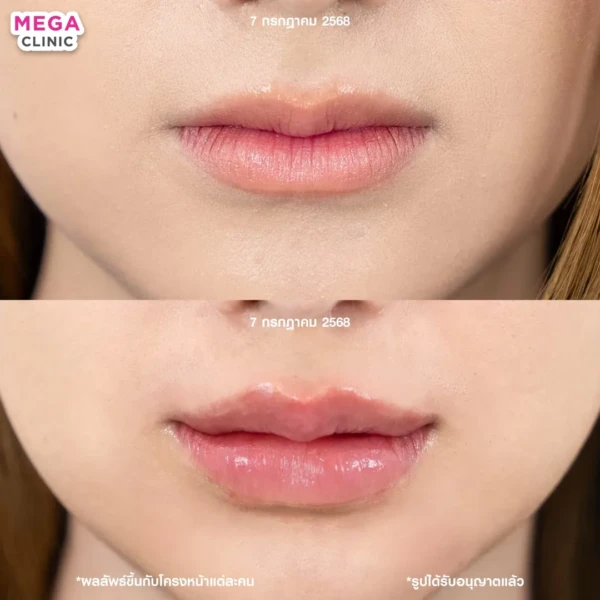 รีวิว ฟิลเลอร์ปาก