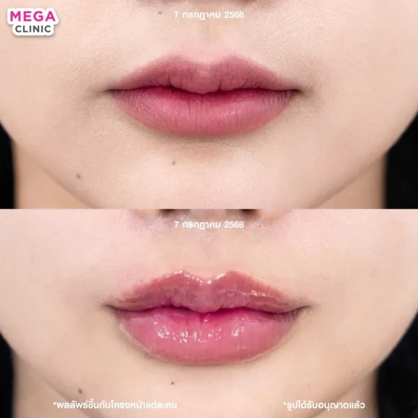 รีวิว ฟิลเลอร์ปาก