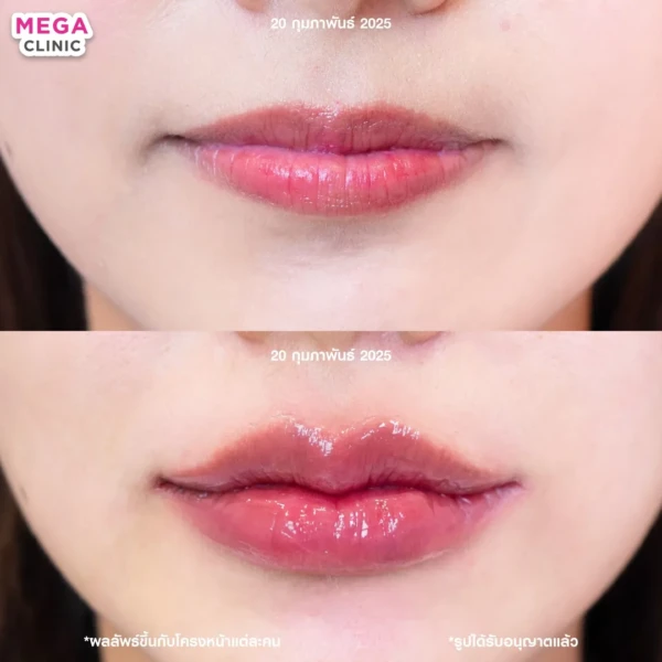 รีวิว ฟิลเลอร์ปาก