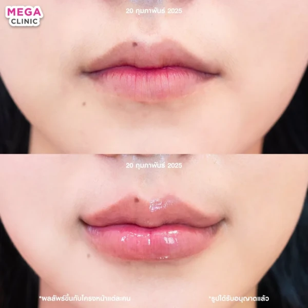 รีวิว ฟิลเลอร์ปาก