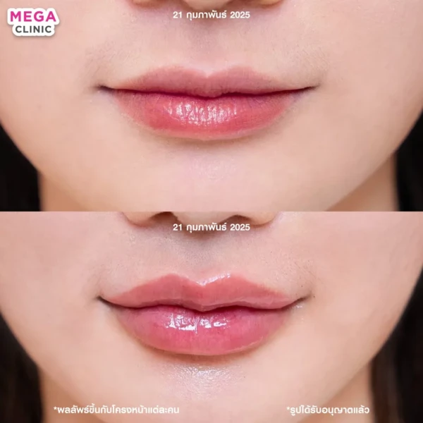 รีวิว ฟิลเลอร์ปาก