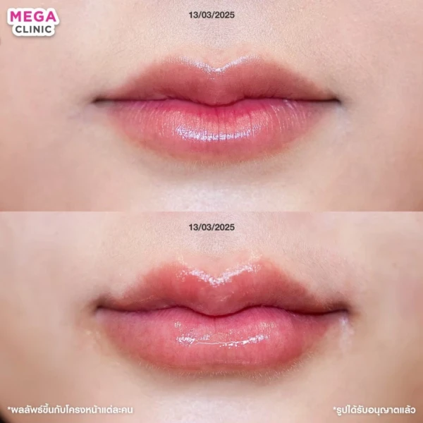 รีวิว ฟิลเลอร์ปาก