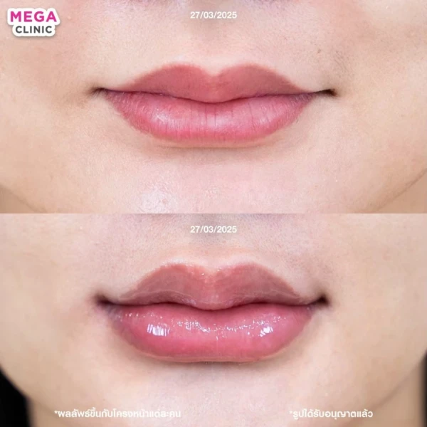 รีวิว ฟิลเลอร์ปาก