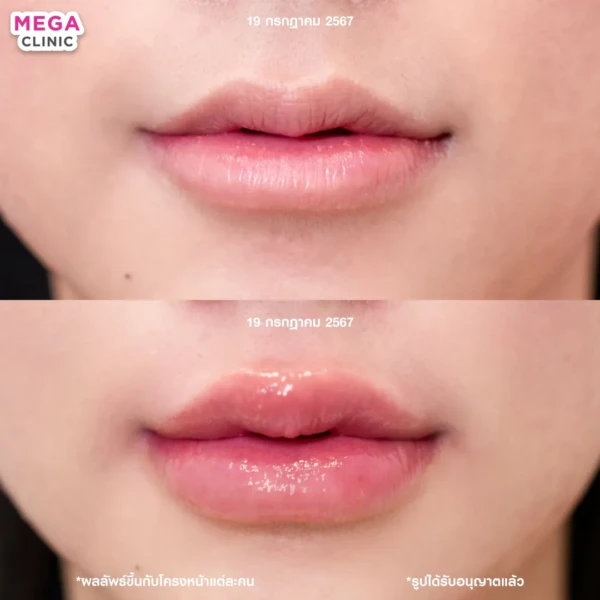 รีวิว ฟิลเลอร์ปาก