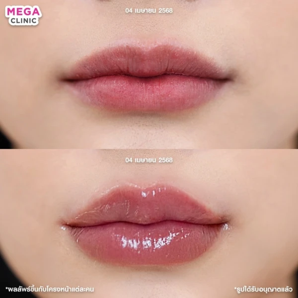 รีวิว ฟิลเลอร์ปาก