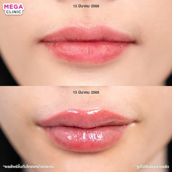 รีวิว ฟิลเลอร์ปาก