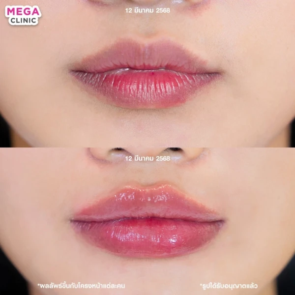 รีวิว ฟิลเลอร์ปาก