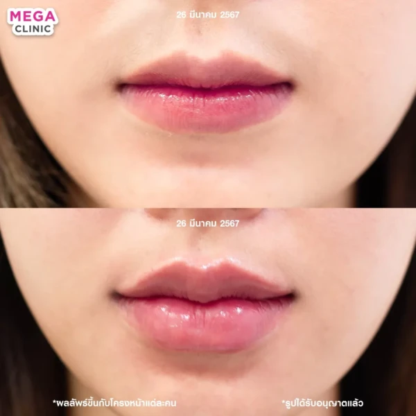 รีวิว ฟิลเลอร์ปาก