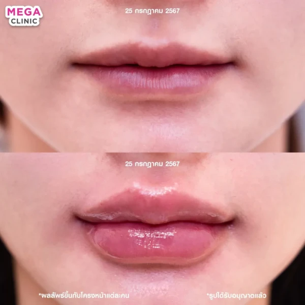 รีวิว ฟิลเลอร์ปาก