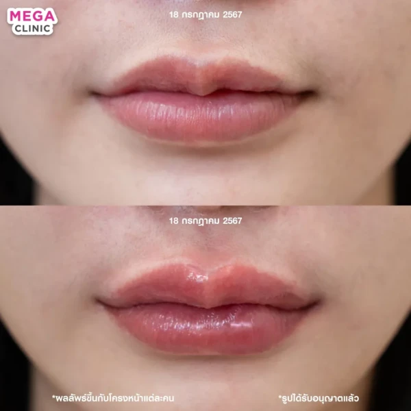 รีวิว ฟิลเลอร์ปาก