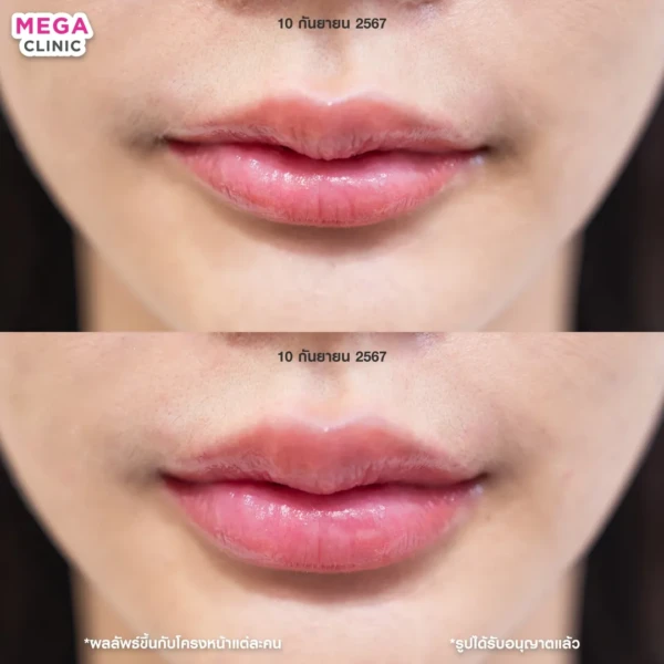 รีวิว ฟิลเลอร์ปาก