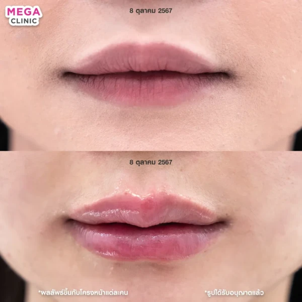 รีวิว ฟิลเลอร์ปาก