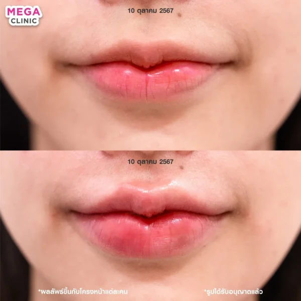 รีวิว ฟิลเลอร์ปาก