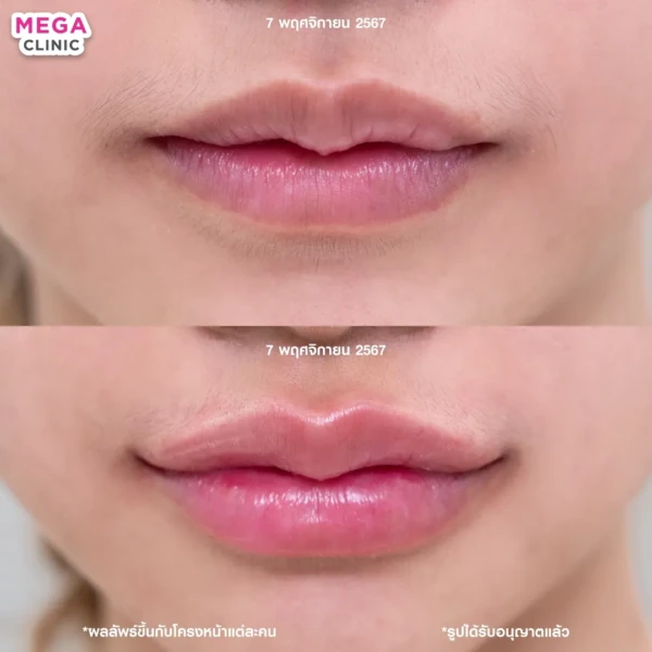 รีวิว ฟิลเลอร์ปาก