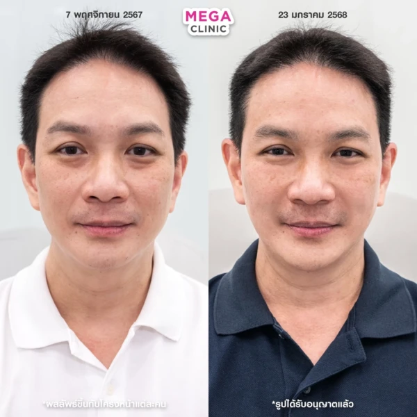 眼底填充剂评论