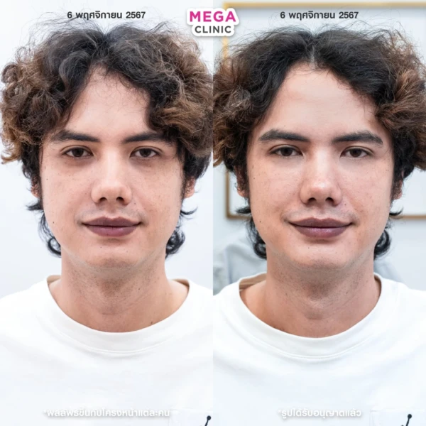 眼底填充剂评论