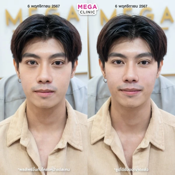 眼底填充剂评论