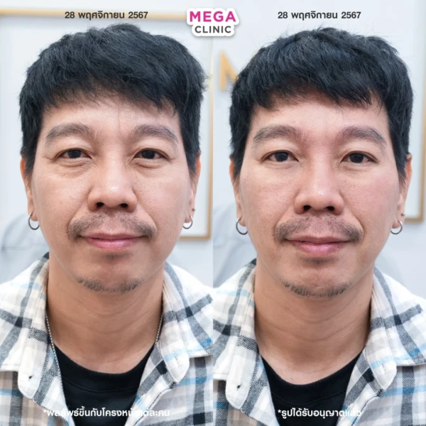 眼底填充剂评论