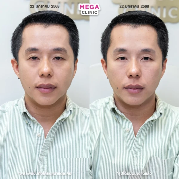 眼底填充剂评论