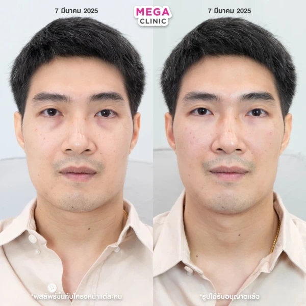 眼底填充剂评论