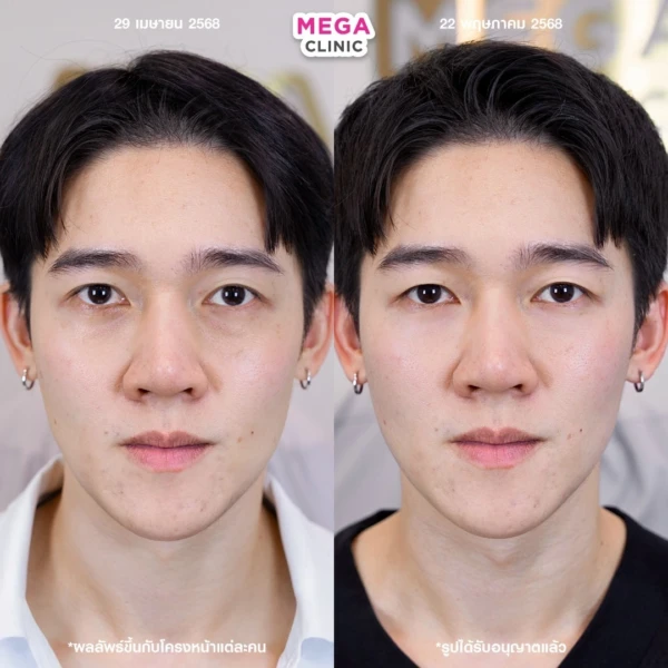 眼底填充剂评论