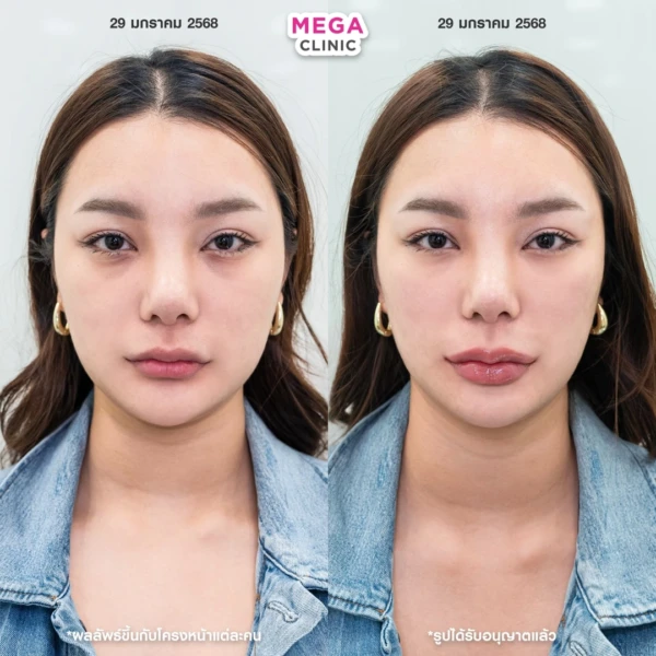 眼底填充剂评论